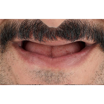 Full Mouth Rehab Before